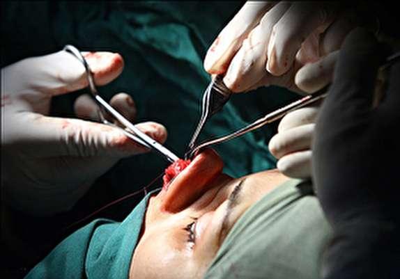 رئیس انجمن تحقیقات راینولوژی ایران عنوان نمود؛ عمل بینی، مشکل ترین جراحی پلاستیک در بدن، چه کسانی باید بینی خود را عمل نمایند؟