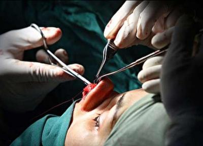 رئیس انجمن تحقیقات راینولوژی ایران عنوان نمود؛ عمل بینی، مشکل ترین جراحی پلاستیک در بدن، چه کسانی باید بینی خود را عمل نمایند؟