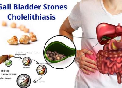 سونوگرافی در کیسه صفرایم سنگ دیده! آیا باید حتما عمل کنم؟