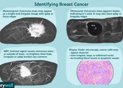تفاوت توده های پستان خوش خیم و بدخیم در تصویربرداری چیست؟